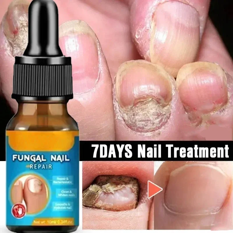 Anti Infection Paronychia Onychomycosis Nail Fungus Treatment  Serum Toe  Fungal Repair Products  Hand Foot Care  Removal Gel