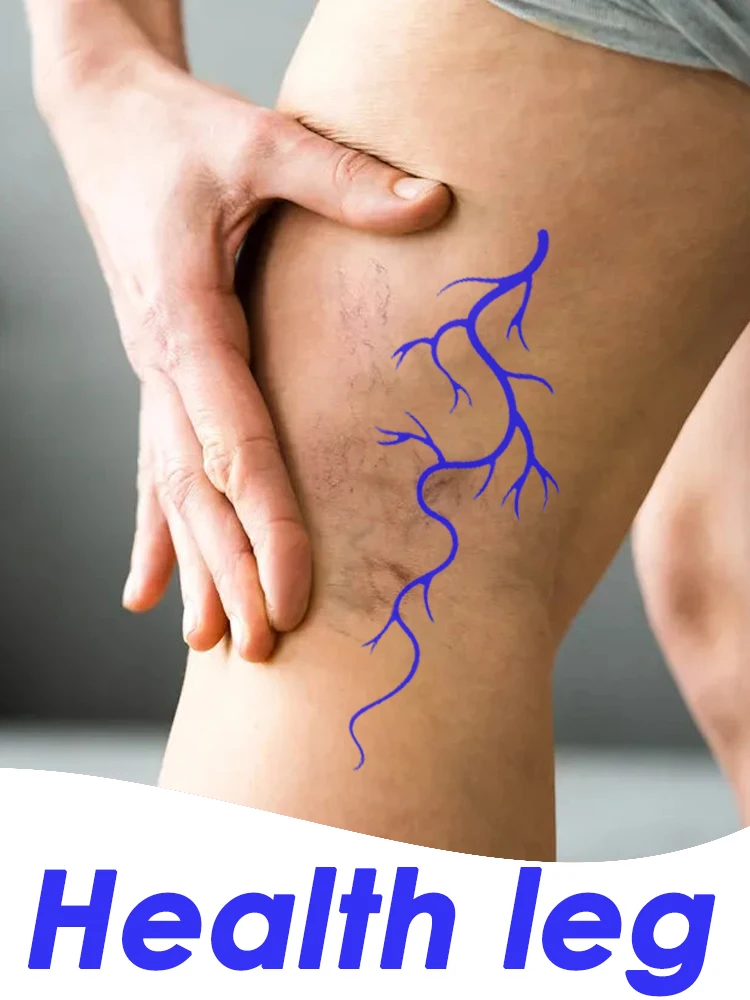 

Varicose Vein Lampshade Therapy Effective Improved Blood Circulation Relief Of Dilated Vasculitis In The Legs Phlebitis