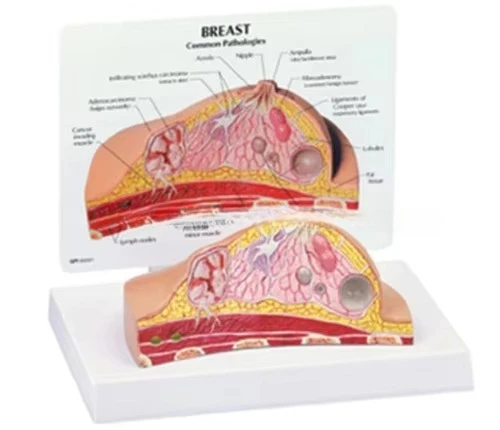 Medical Anatomy Teaching Model of Female Breast Pathology