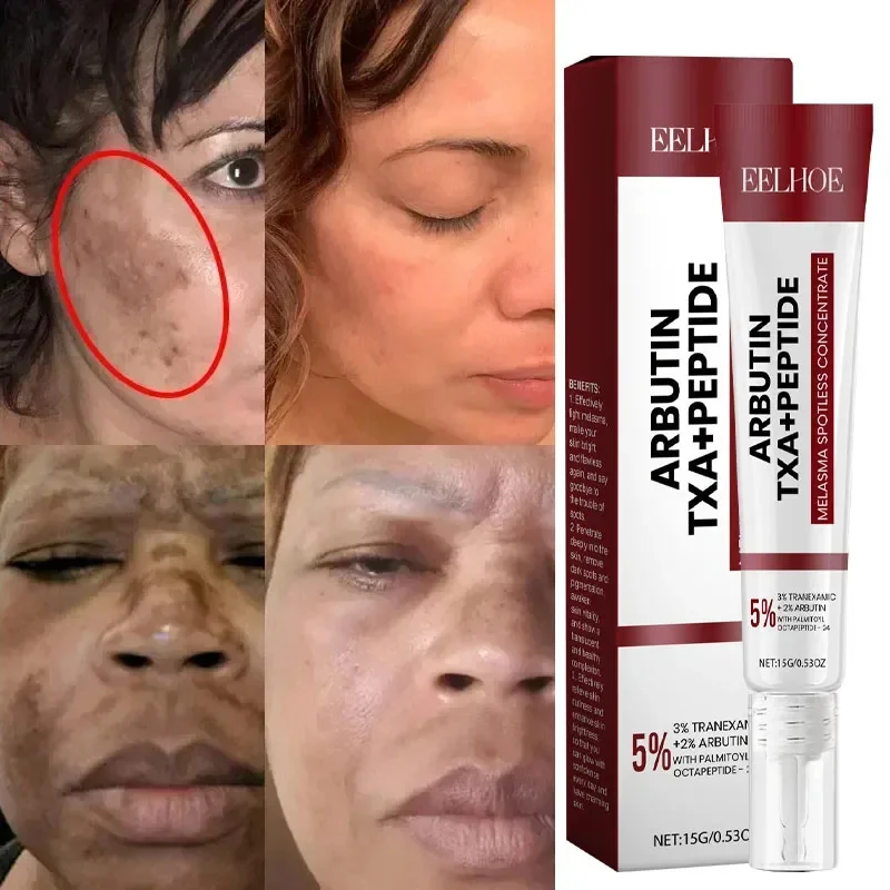 Crema sbiancante lentiggine Melasma macchie scure prodotti per la rimozione della pigmentazione dissolvenza macchia melanina riparazione illuminare