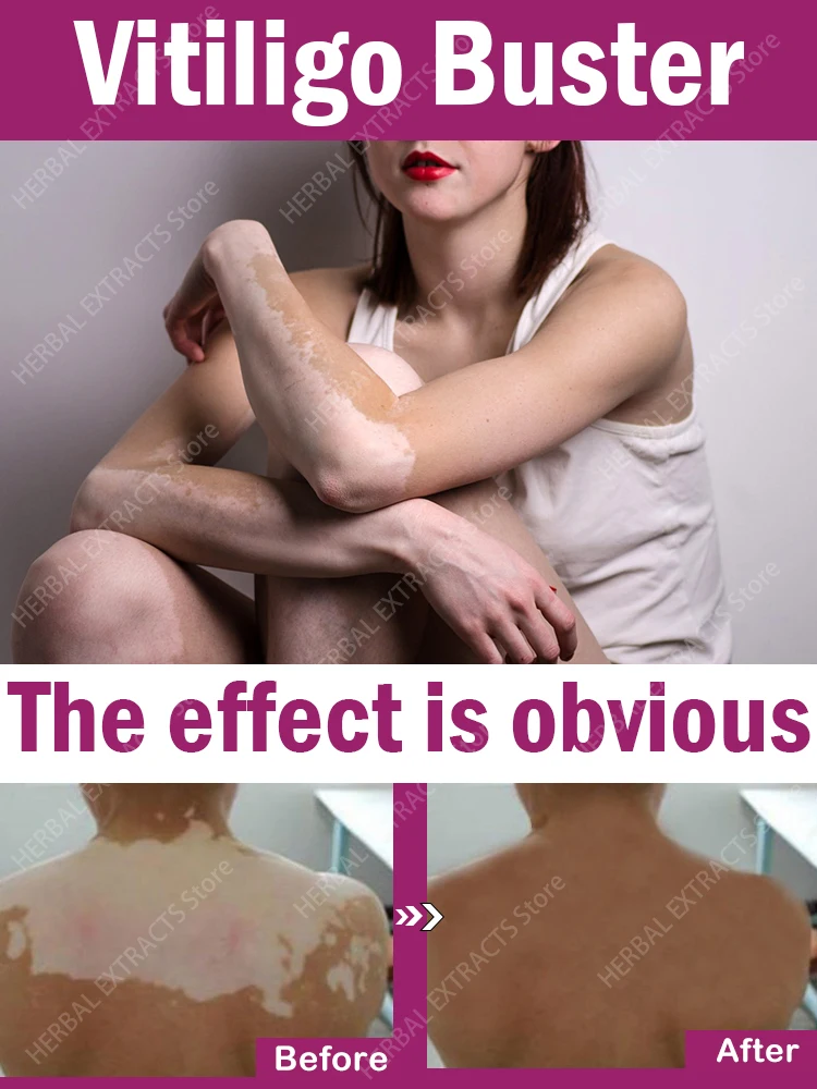 7 day fast eliminate  vitiligo cream effectively resists white spot and improves skin immunity