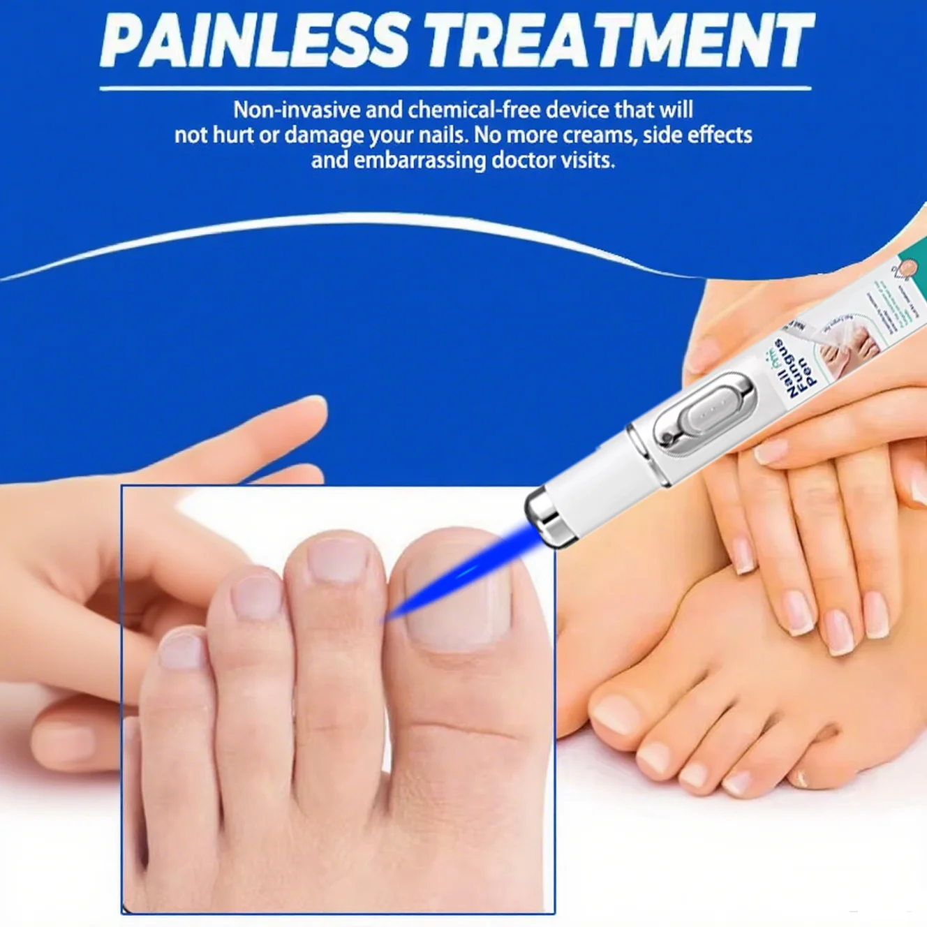 

Лазерная ручка для ухода за ногами с синим светом – эффективно для облегчения грибка ногтей