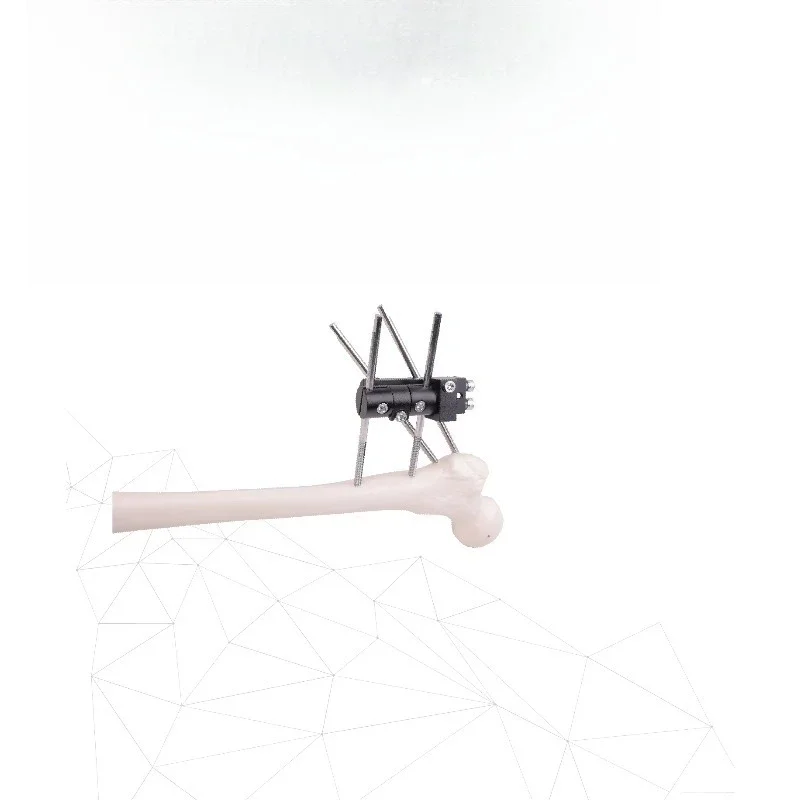 Fracture External Fixator Leg Extremities Fracture Orthopedic Fixation for Correct Deformities