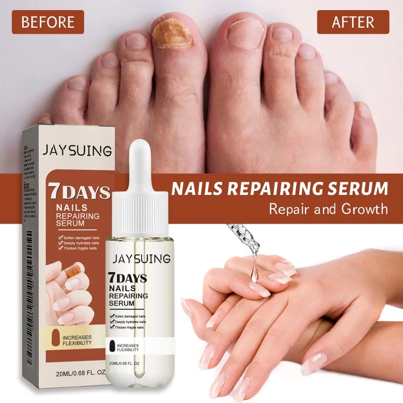 7Days Nail Repair Essence Repair Ingrown Toenails Thickening Onychomycosis Relieve Toenail Pain Hand Foot Nail Repair Serum