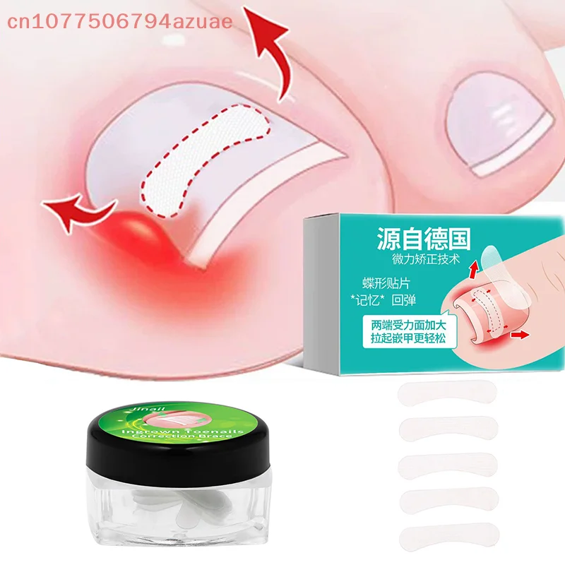 10Pcs Eingewachsene Zehennagel Korrektur Werkzeug Richt Clip Klammer Eingewachsene Zehennagel Behandlung Elastische Patch Aufkleber Pediküre Werkzeug