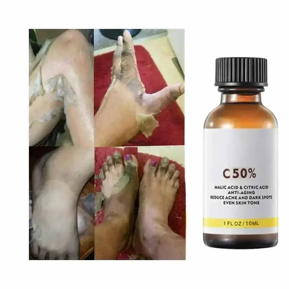 Avec acide malique et acide citrique pour le visage Peel 40% Sérum Peeling Peeling Sérum Peeling Peel chimique Essence nourrissante blanchissante