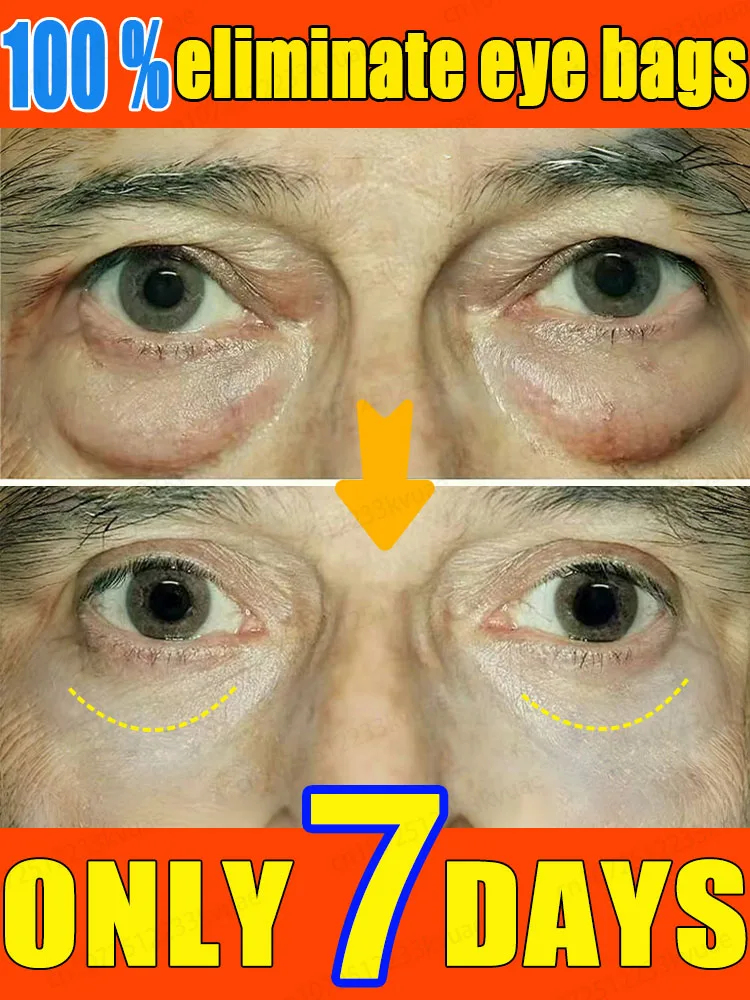 

Eye Bag Killer - Natural Anti-Puffiness Eye Cream, Eliminates Puffiness and Dark Circles in 7 Days, Improves Eye Area Skin