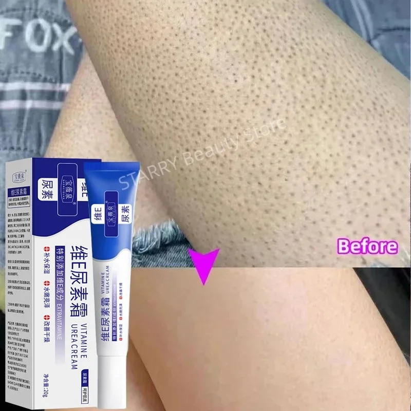 Curing Keratosis Pilaris Chicken Follicle Skin Repair Cream Body Dark Spot Remove Whitening Smooth Moisturize Skincare Body loti