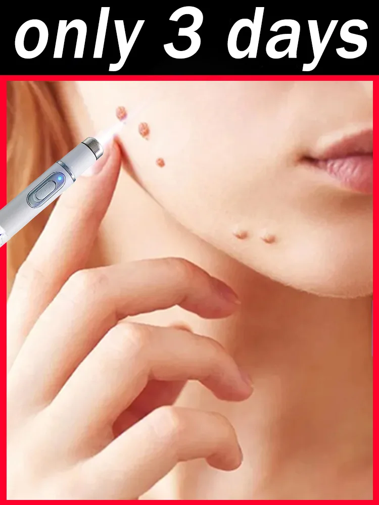 

Усовершенствованный аппарат 2-го поколения для быстрого удаления родинок и родинок на ногах