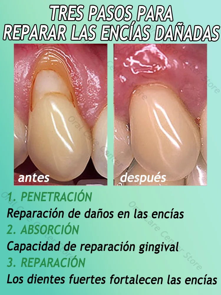 Proteja a saúde das gengivas, alivia rapidamente a dor de dente, repara gengivas danificadas e elimina o sangramento das gengivas