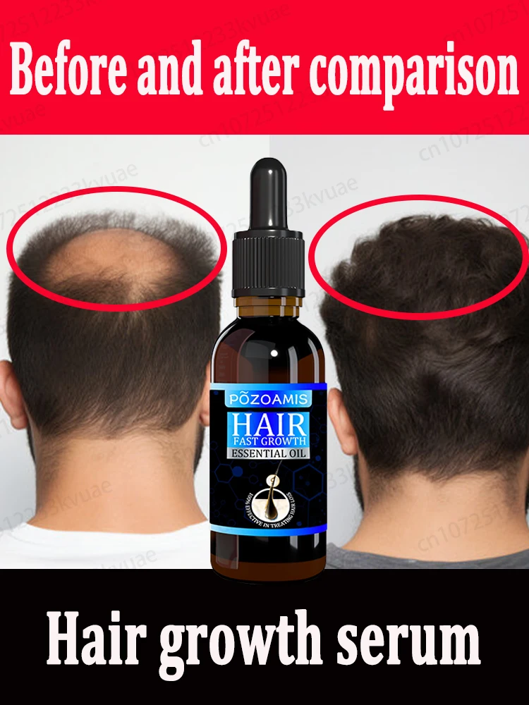 Hair growth oil rapid hair growth effectively repairs baldness hereditary hair loss postpartum hair loss seborrheic alopecia