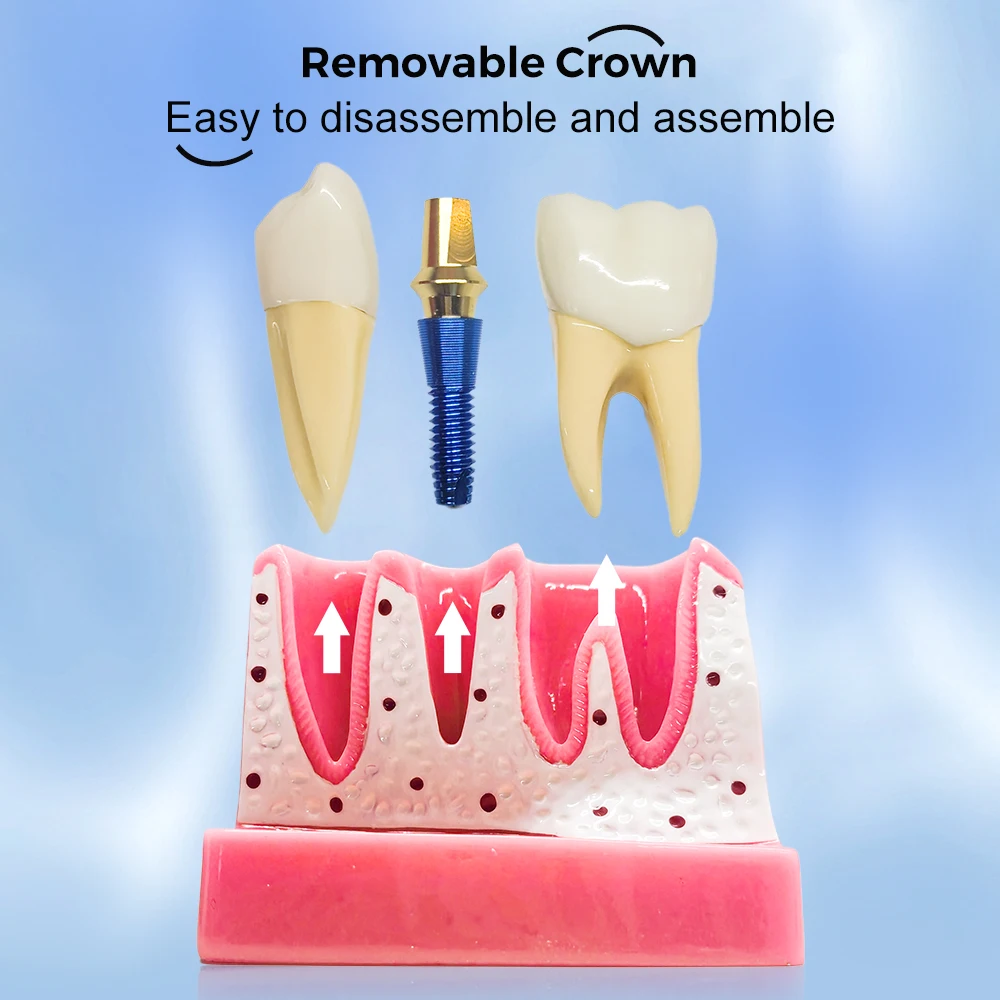 Dental Implant Model 4 Times Removable Analysis Crown Bridge Demonstration Teeth Model for Dental laboratory, Class Education