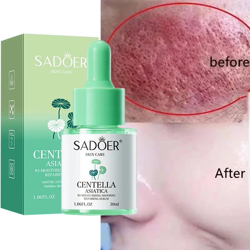Facial Redness Repair Serum Improve Sensitive Skin Dryness Moisturizer Hydrating Sooth Lotion Removal Rosacea Korean Cosmetics