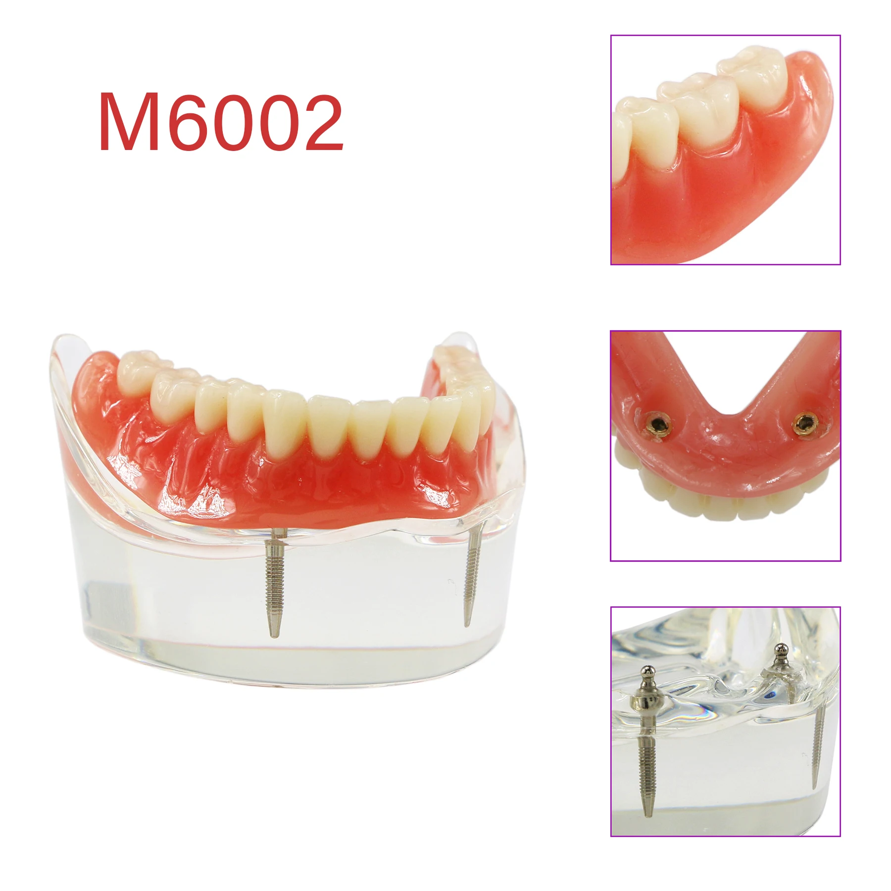 

Dental Implant Teeth Demo Model Overdenture Restoration With 2 Implants Model M6002