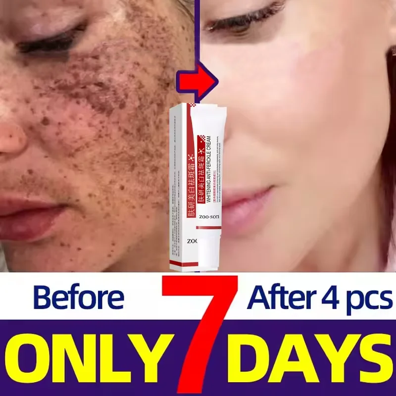 

2pcs Fast Eliminate Melasman Cream Powerful Spot-removing Whiten Cream Brighten Melanin Pigmentation Dark Spots Korean Skin Care