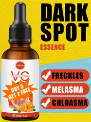 Sproeten Melasma Chloasma Donkere Vlek Op Het Gezicht