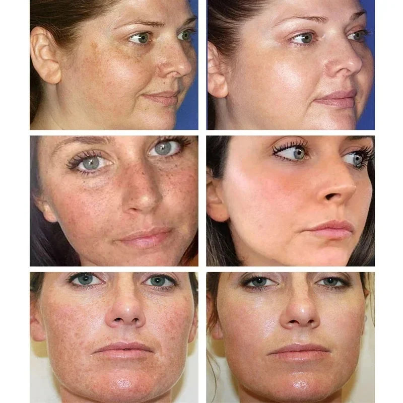 Clareamento De Sarda Creme Remover Manchas Escuras Melanina Melasma Iluminar A Pele Anti-Envelhecimento Reafirmante Hidratante reparação rosto cuidados com a pele