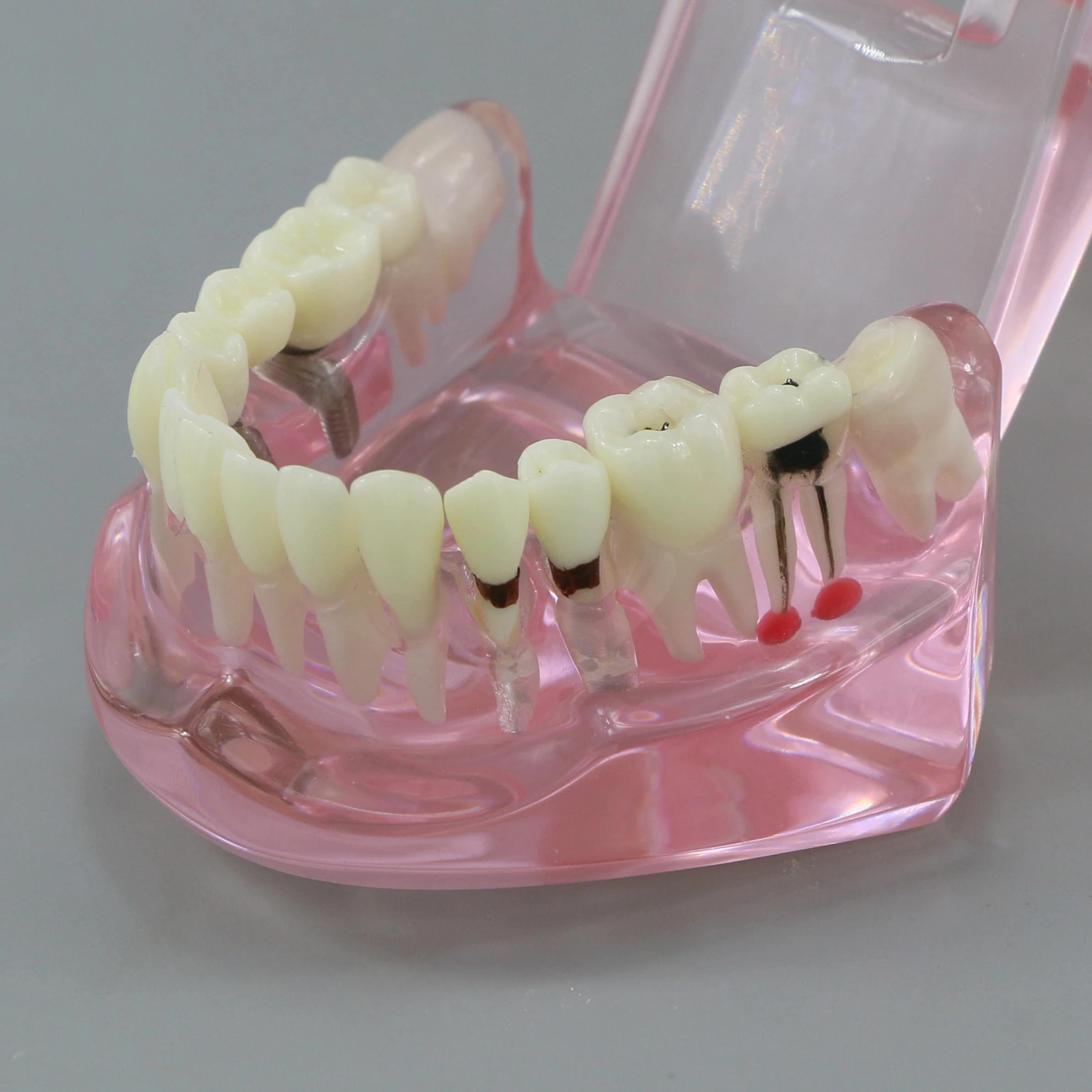 Dental Teeth Model Teaching Model Implant Disease Teeth Repair Restoration Bridge for Dentist Teaching Studying Demo M2001 Pink.