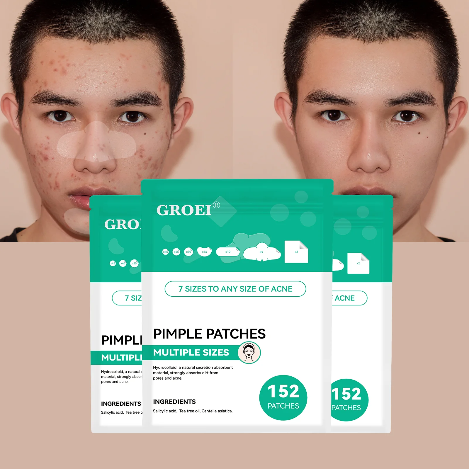 Invisible Acne Spot Treatment Patches 152Pcs - Hydrocolloid & Salicylic Acid, Multi-Size Pimple Covers for Face & Body Use. (