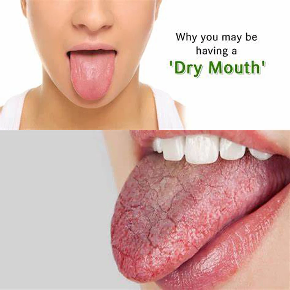 Dry Mouth Relief Gel Treatment Cream GC Mint Lemon Japan Made Throat Dental Teeth Oral Moisturizing Spray