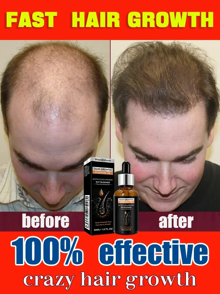 Hot selling product, 99% of buyers buy again, have more and more hair, say goodbye to baldness, thick hair