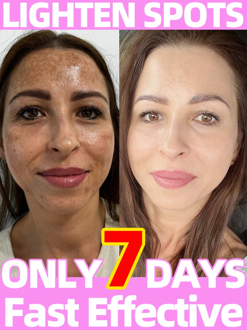 

Dark Age Sun Spot Clear Freckles Chloasma