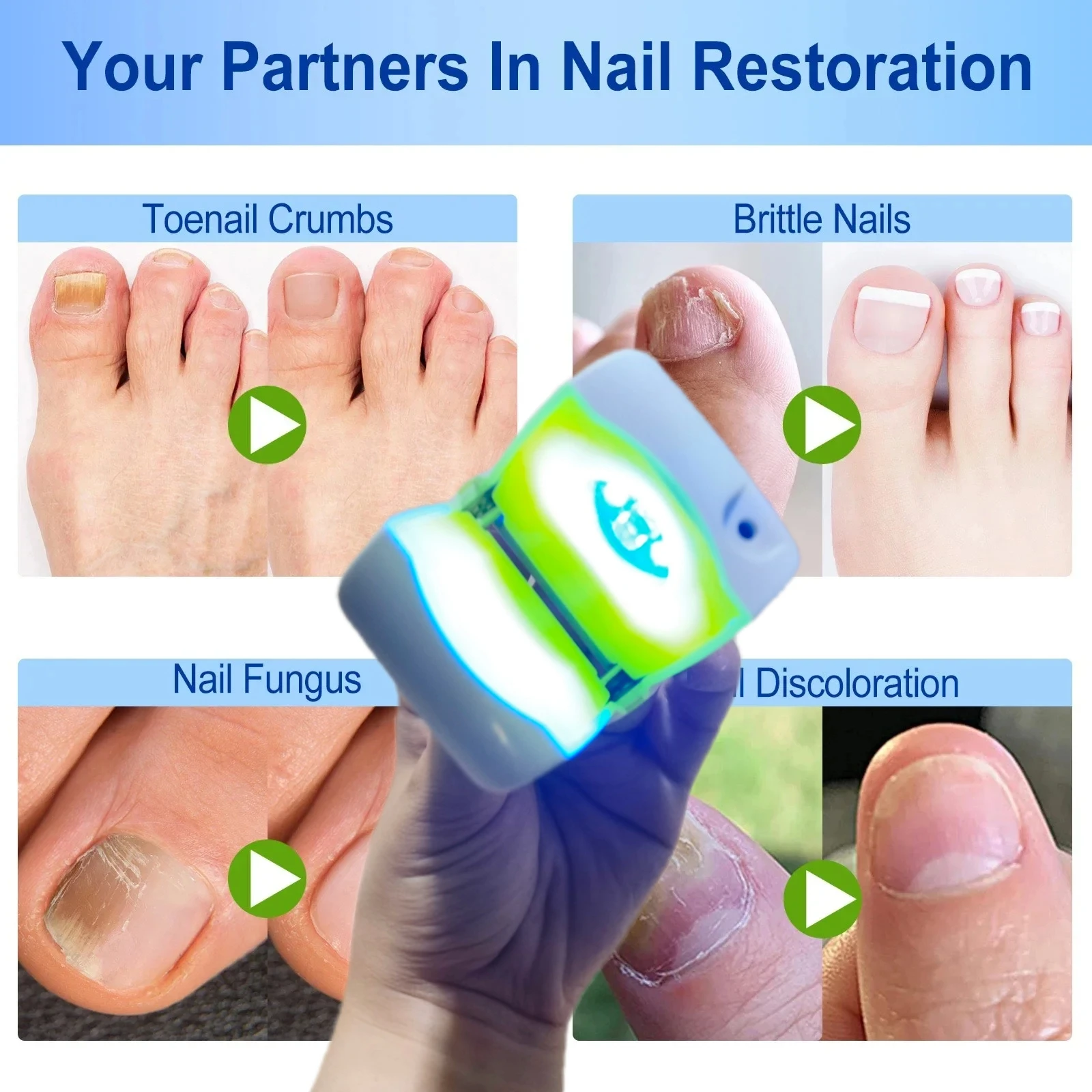

Advanced Laser Therapy for Nail Fungus, Clinical Grade Home Use Device to Remove Onychomycosis and Clean Nails