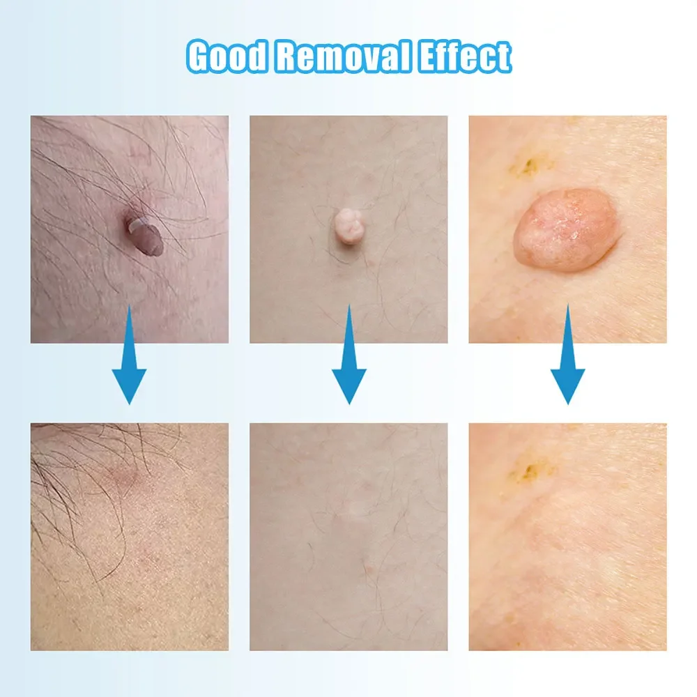 Auto Skin Tag Removal ชุดเครื่องมือไม่เจ็บปวดผิวป้าย Mole สิวกําจัดหูดปากกาทําความสะอาด Swabs Facial Skin Care เครื่องมือความงาม
