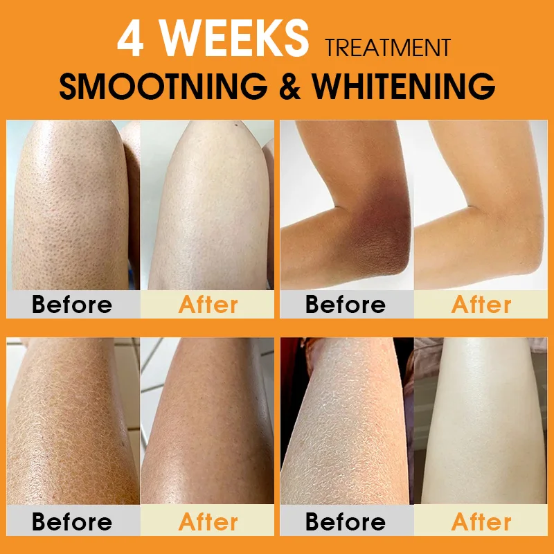 Turmeric Body Cream Treatment Keratosis Pilaris Lotion Chicken Skin Removal Rough Bumpy Moisturizer Whitening Creams Skincare