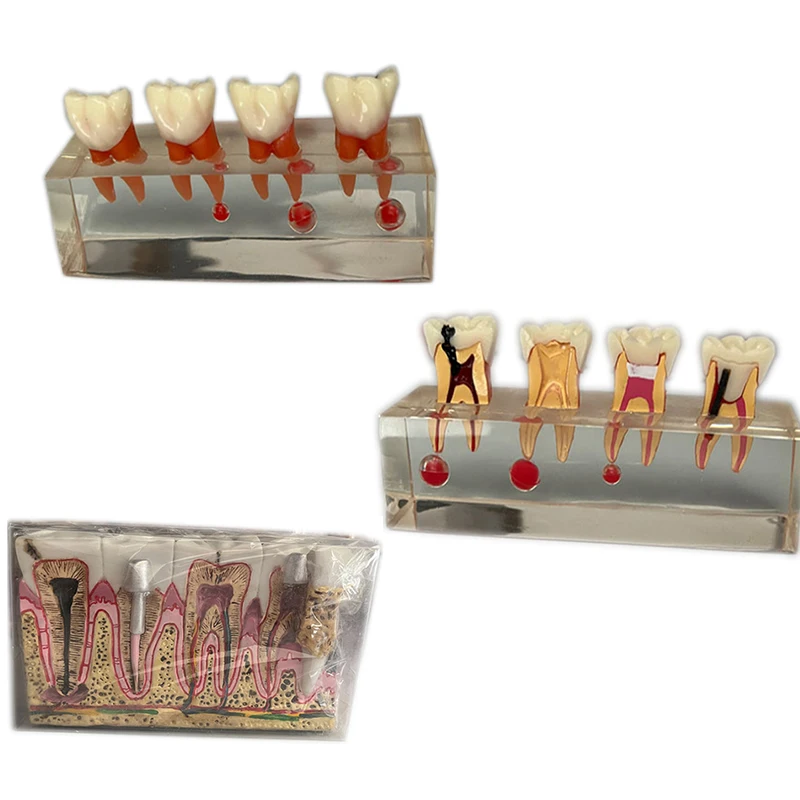 

Dental Teaching Model Nongma Pathological Model Posterior Tooth Anatomical Details Model with Dentist Nerves