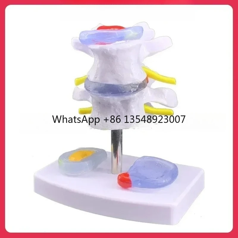 Intervertebral Disc Herniation, Skeletal Pathology, Lumbar Spine Skeletal Teaching Model
