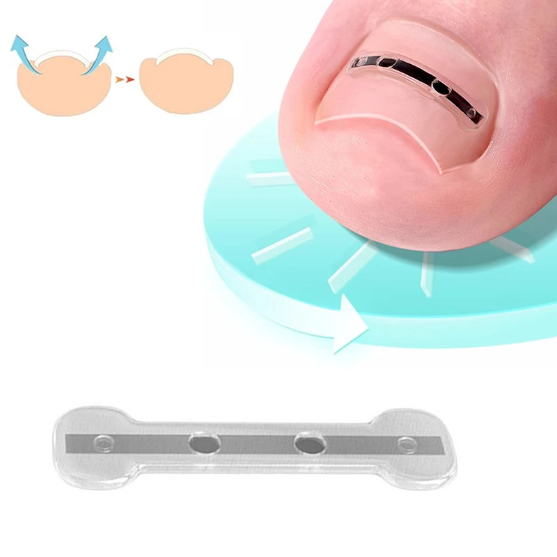 Ingrown Toenail Correction Tool Ingrown Toe Nail Treatment Elastic Patch Sticker Straightening Clip Brace Pedicure Tool