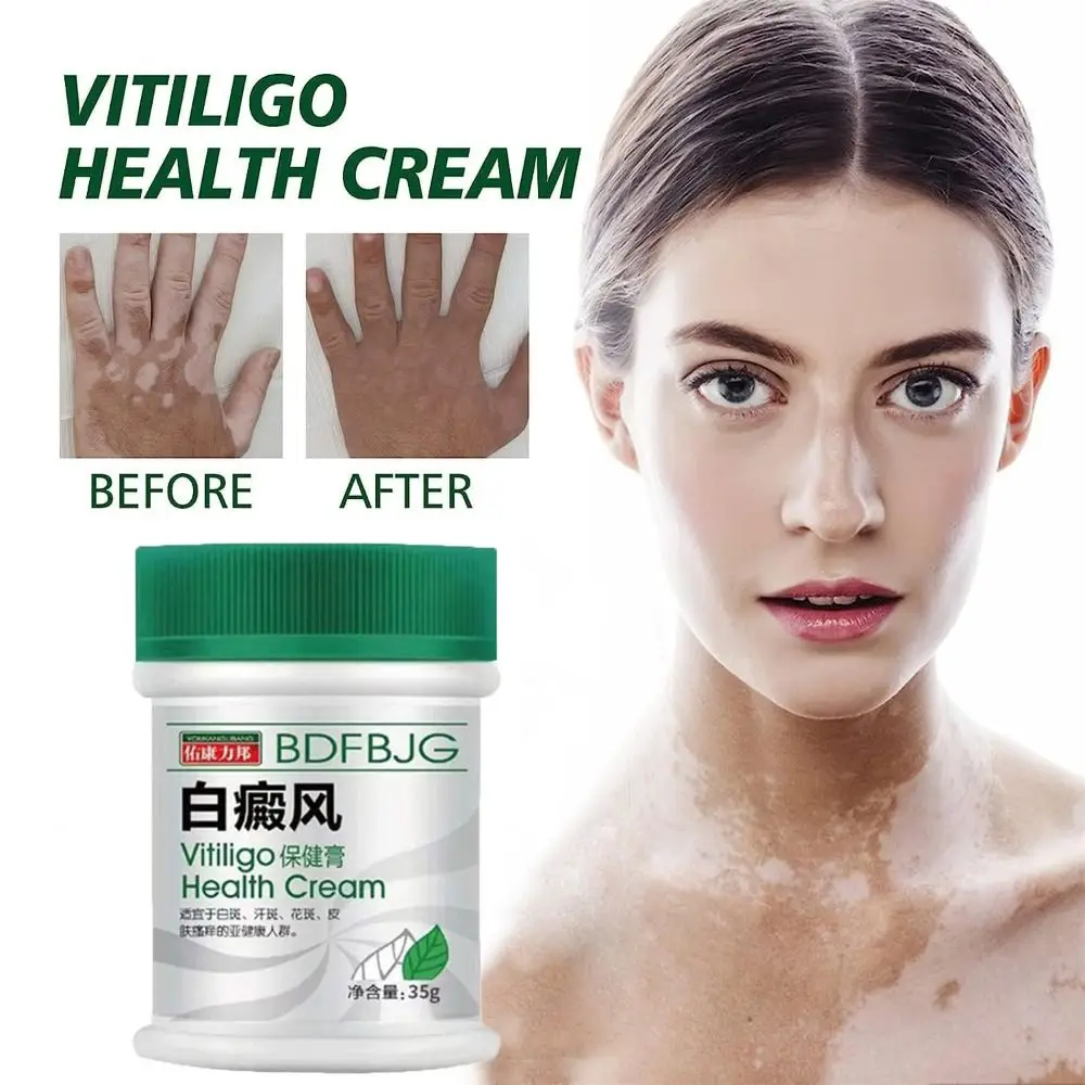 Natural TreatVitiligo Soothing Cream Skin Care Improve Skin Discoloration Vitiligo Care Cream Moisturizes Fast Penetration