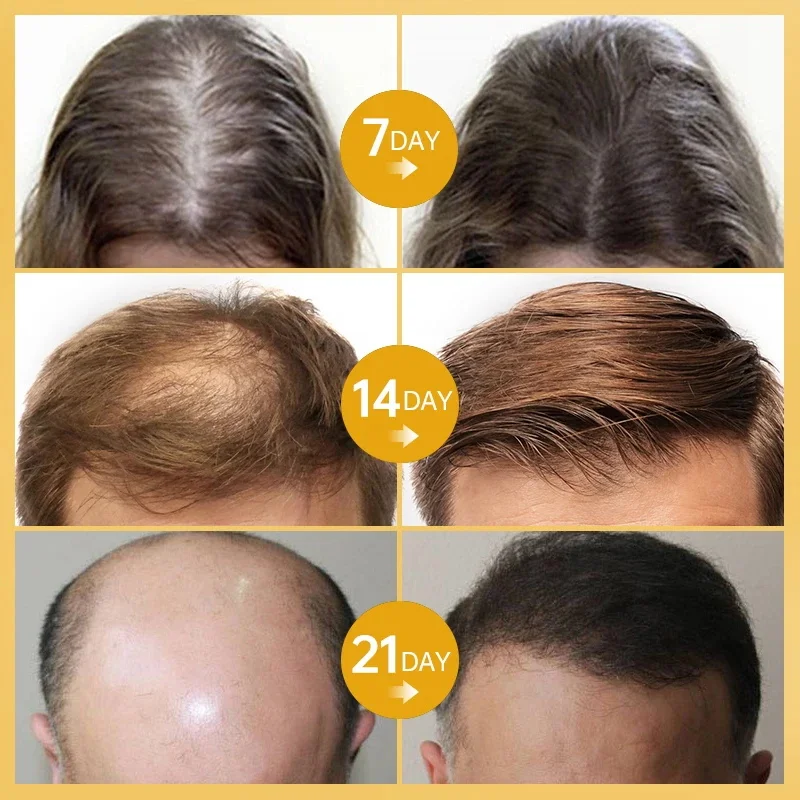 Produtos para o crescimento do cabelo do gengibre para homens e mulheres Tratamento da perda de cabelo Rebrota rápida Reparação de engrossar Líquida Nutritiva de Biotina