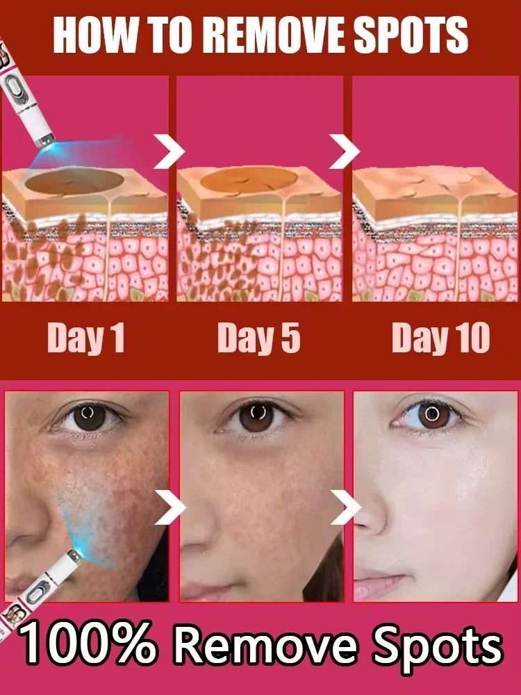 Freckles Melasma Melasma Dark Spots on Face Laser Pointer