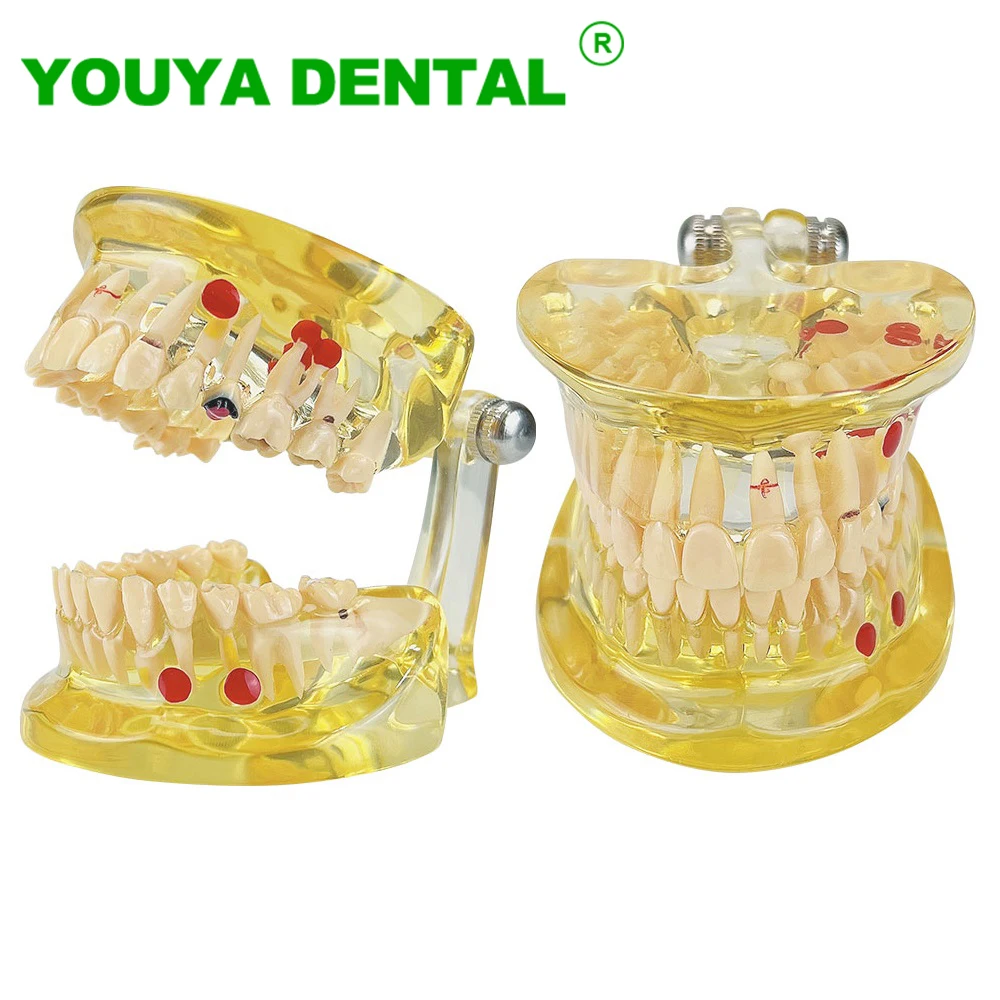 Dental Teaching Study Model With Half-Detachable Tooth Medical Science Disease Dentistry Pathological Model Dental Products