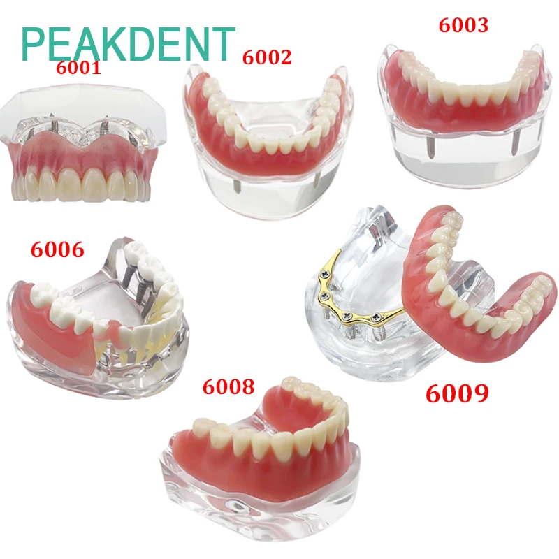 

Исследование съемных верхних и нижних щелочных имплантатов для медицинского преподавания зубов, модель зубного имплантата с покрытием, модель протеза