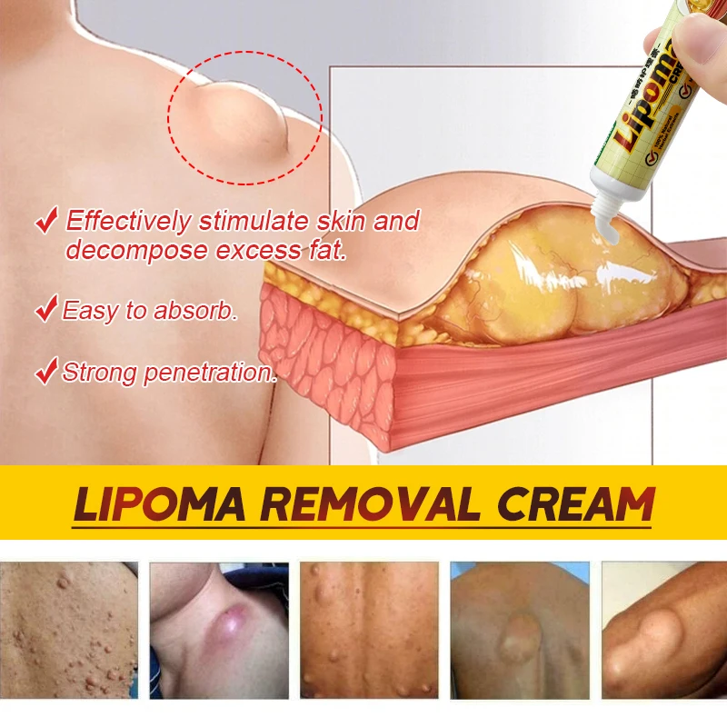 1Pcs Lipoma Removal Cream Removes Lipoma Fibroids Herbal Skin Swelling Cellulite Ointment Tumor Exfoliating Health Care G040