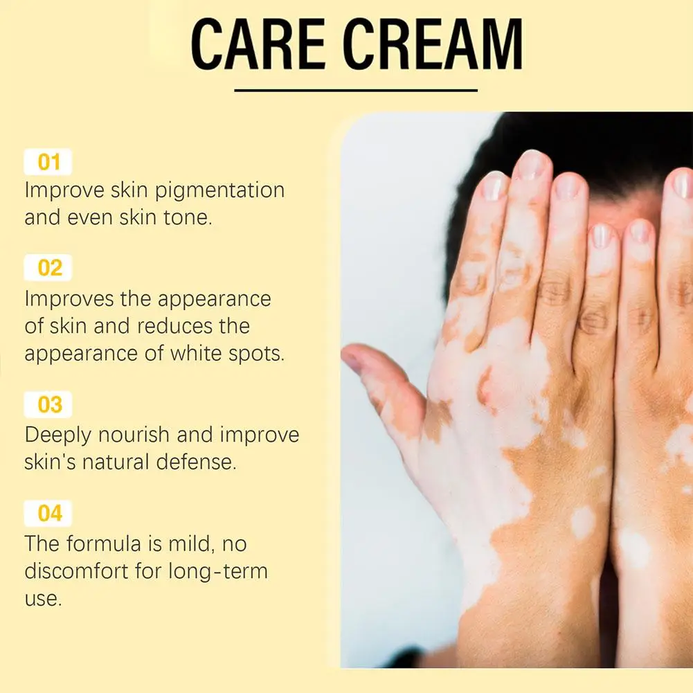 Crema de tratamiento de Vitiligo para reparación de abejas, cuidado de la piel, promueve la producción, inhibe las manchas blancas, alivia la propagación, crema de tratamiento