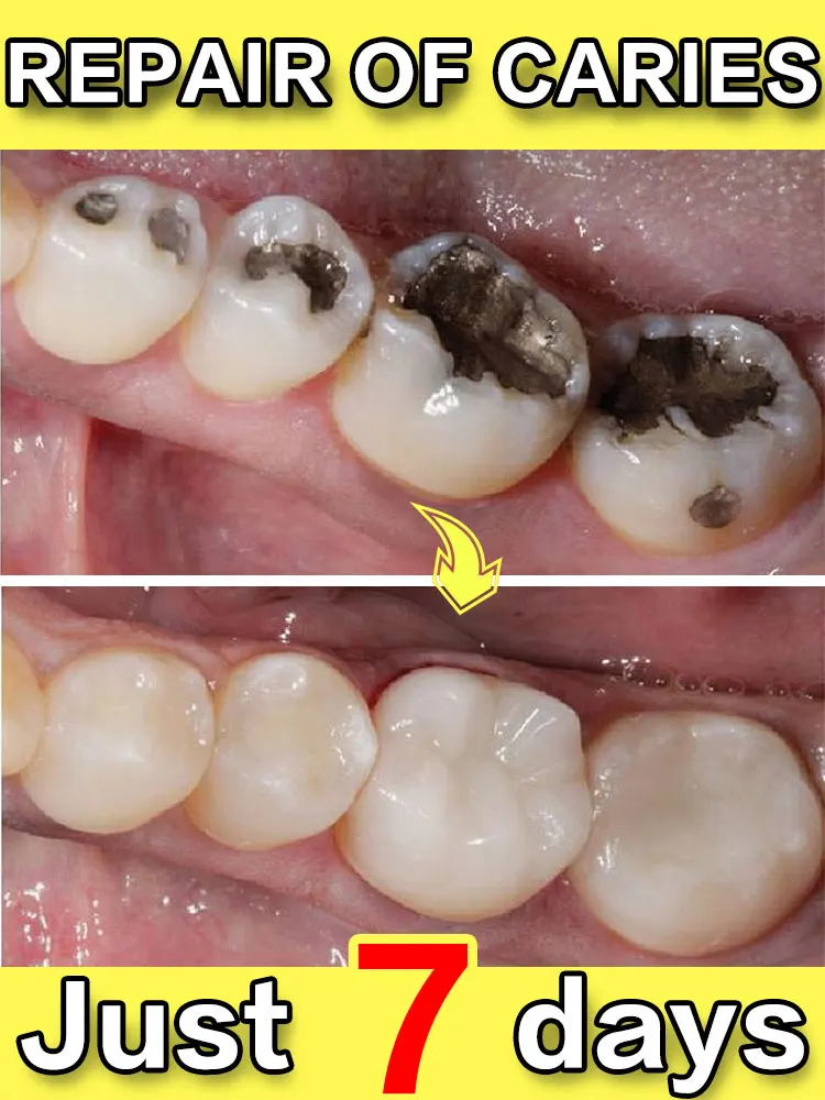 Risolvi carie e carie dentate e proteggere i denti anti-carie