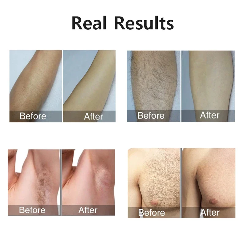 Thumbnail 3 - #48 Ranked Hair Removal Devices Picks in 2026