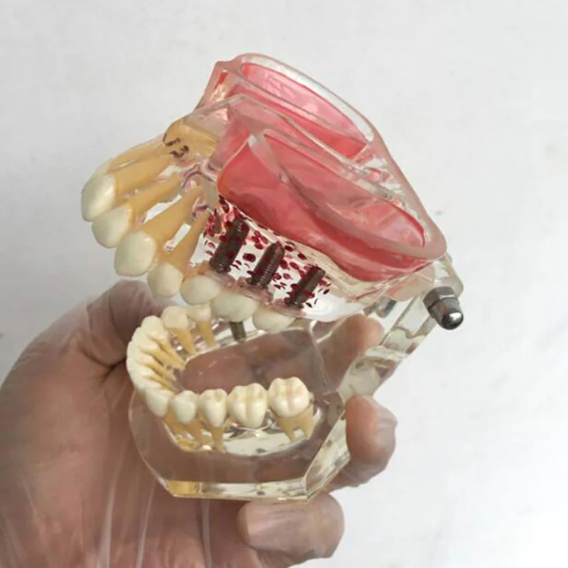 Dental Maxillary Sinus Implant Study Teaching Model Resin Manual Exercise Practice Demonstration