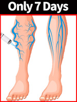 blue light pen solve varicose veins, hot sale leg care tools