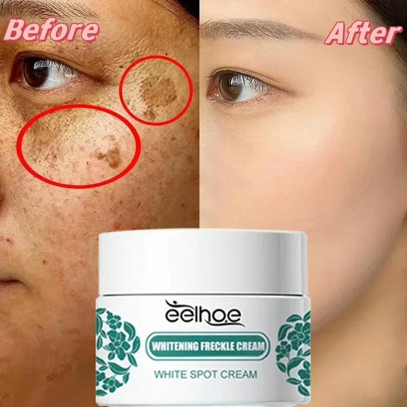 Niacinamid Whitening Sommersprossencreme Entfernen dunkle Flecken Melasma Pigmentierung Aufhellende Creme Verblassen Fleck Melanin Reparatur Hautpflege