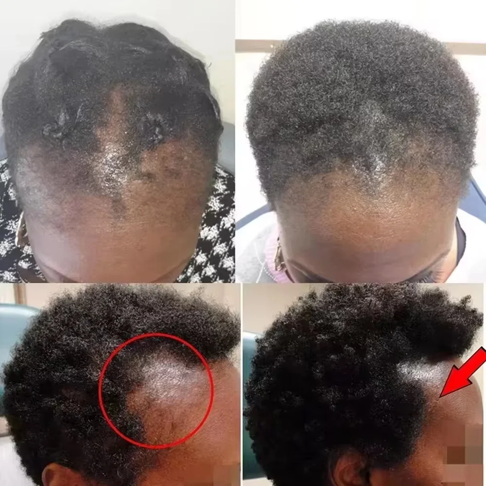 

Набор для быстрого роста волос Батана Oil Traction Alopecia Маска для волос против выпадения волос Масло для роста волос Лечение облысения Уход за волосами