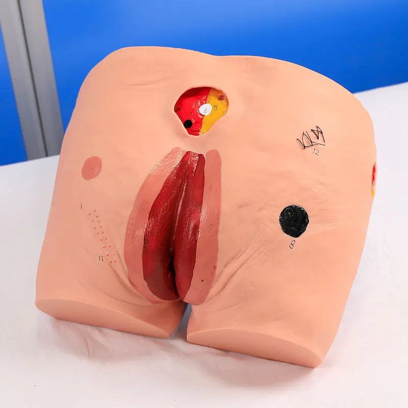 Bedsore Nursing Learning Model Medical Science Old 4-stage Bedsore Nursing Model Pressure Sore Wound Nursing Training
