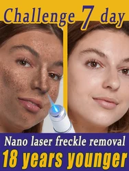 Laser quick repair of facial freckles