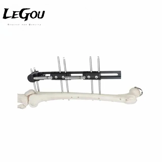 LeGou Professional OF type external fixator lengthening external fixation