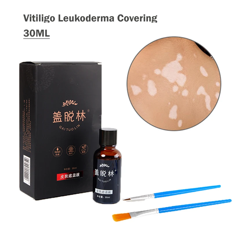30ml Leukoderma Covering Liquid Waterproof Concealer Cream Liquid Women Men Face Discolored Skin Vitiligo Patches Makeup