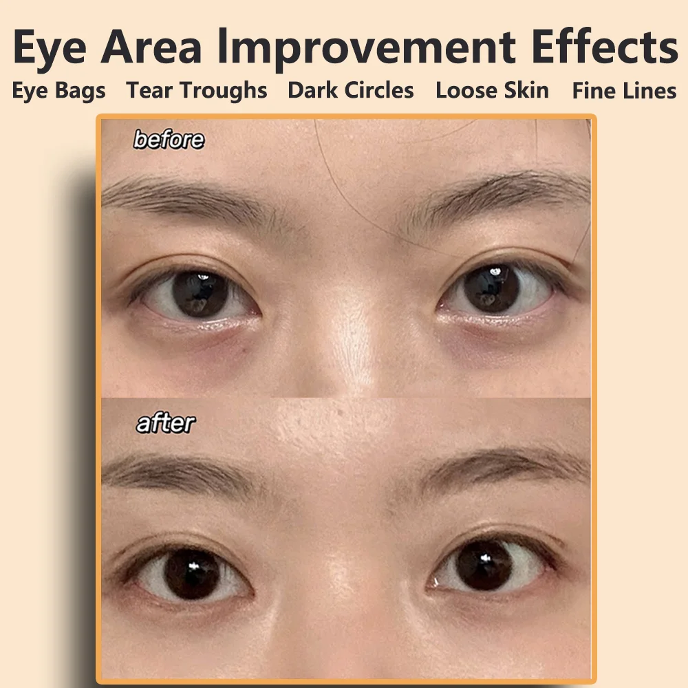 Ems Pulse Microcurrent Eye Care อุปกรณ์นวดตาบรรเทาความเมื่อยล้านวดลดความหมองคล้ํา Eye บวม Anti-Wrinkle